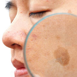 Почему появляются пигментные пятна и как от них избавиться?