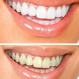 Отбеливаем зубы в домашних условиях